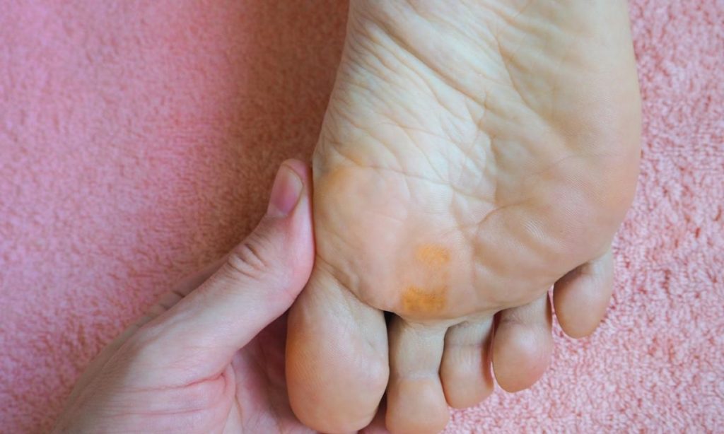Calosidades nos pés Como acabar e remover calos dolorosos